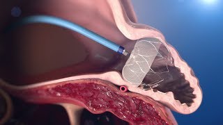 WATCHMAN Implantation Technique [upl. by Norry]