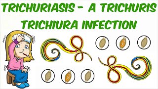 Trichuriasis  A Trichuris trichiura Infection [upl. by Axel665]