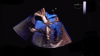 Lipomatous hypertrophy of the atrial septum LHAS [upl. by Ck]