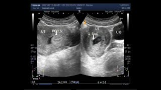 Ultrasound Video showing Incomplete abortion [upl. by Neelie723]