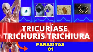 TRICURÍASE  TRICHURIS TRICHIURA VERMINOSE  PARASITOLOGIA  INFECTOLOGIA [upl. by Vita]