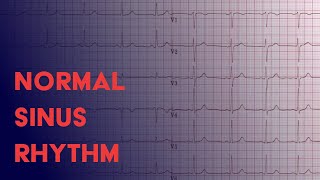 Normal Sinus Rhythm  EKG ECG Interpretation [upl. by Giraud]