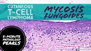 Mycosis Fungoides Cutaneous TCell Lymphoma 5Minute Pathology Pearls [upl. by Audwin]