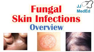 Overview of Fungal Skin Infections  Tinea Infections [upl. by Willabella]